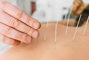 Acupuncture