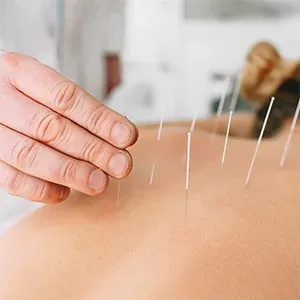 Acupuncture